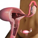 Adenomatous polyp of the endometrium of the uterus: treatment