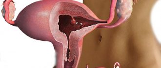 Аденоматозный полип эндометрия матки: лечение