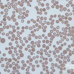Anisocytosis is a condition in which red blood cells of abnormal size are detected in the blood.