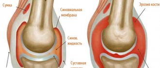 Arthritis of the knee joint