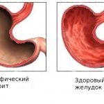 атрофия желудка