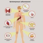 Autoimmune diseases