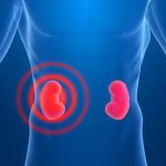what is kidney hydronephrosis