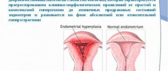 What is hyperplasia of the cylindrical, glandular epithelium of the cervical canal