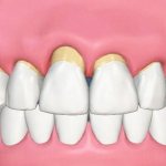 что такое пародонтоз зубов и как лечить его