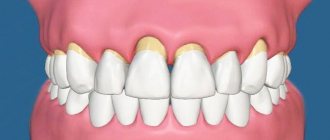 что такое пародонтоз зубов и как лечить его