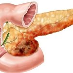 Деструктивный процесс приводит к необратимому отмиранию тканей поджелудочной железы