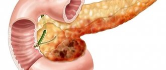 The destructive process leads to irreversible death of pancreatic tissue