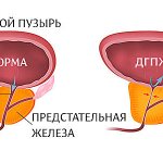 ДГПЖ - доброкачественная гиперплазия предстательной железы