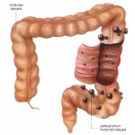 Intestinal diverticulosis: symptoms and treatment