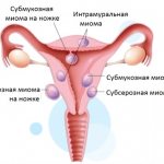 Benign neoplasms of the uterus