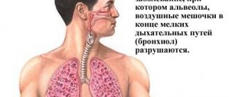 эмфизема лёгких