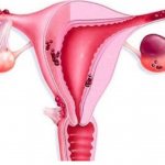 Colon endometriosis