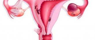 Colon endometriosis
