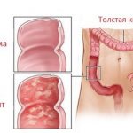 Intestinal enterocolitis: symptoms and treatment in adults
