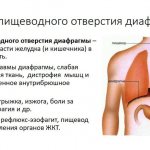 Etiology of hiatal hernia