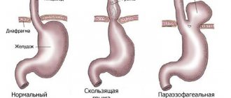 Forms and signs of gastric hernia