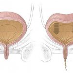 overactive bladder in women treatment reviews