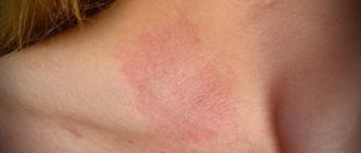 Hypervitaminosis A is manifested by skin rashes, itching and peeling