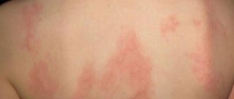 Chronic urticaria in adults photo