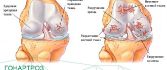 Cartilage is healthy and affected by arthrosis