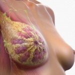 invasive breast cancer