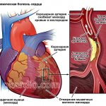ишемическая болезнь сердца