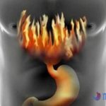 Heartburn: causes and treatment