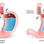 Heartburn occurs due to the reflux of stomach contents into the esophagus