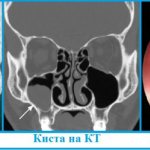 What can a maxillary sinus cyst lead to? How to treat without surgery 