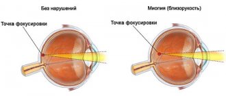 How to treat myopia