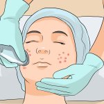 How to treat rosacea
