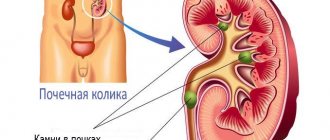 A stone in the ureter is one of the causes of renal colic