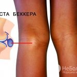 Киста Бейкера развивается в подколенной ямке в основном из-за травм или чрезмерной нагрузки на коленный сустав