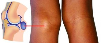 Киста Бейкера развивается в подколенной ямке в основном из-за травм или чрезмерной нагрузки на коленный сустав