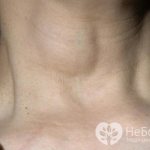 Кисты щитовидной железы чаще развиваются у женщин старше 40 лет