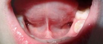 Short frenulum of the tongue in a child