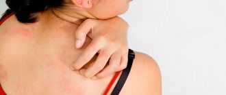 Skin rashes due to giardiasis