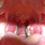Lacunar tonsillitis