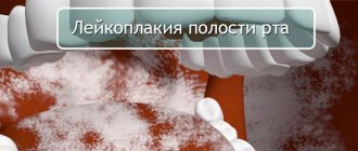 treatment of oral leukoplakia
