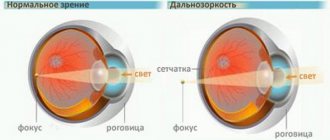 Mechanism of focusing vision on the retina