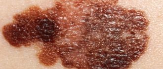 Skin melanoma: life prognosis