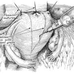 Metroplasty of bicornuate uterus