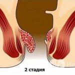 At this stage, hemorrhoids can be cured with conservative measures
