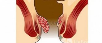 At this stage, hemorrhoids can be cured with conservative measures