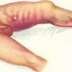 The photo shows gas gangrene of the left lower limb.