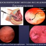 On what day of the cycle is hysteroscopy performed?