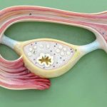 Neoplasm on the ovary