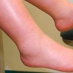 отек ног как симптом рака мочевого пузыря у женщин