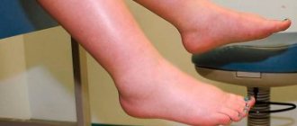 leg swelling as a symptom of bladder cancer in women